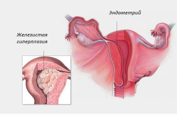 Выскабливание при гиперплазии эндометрия: как проводится, последствия