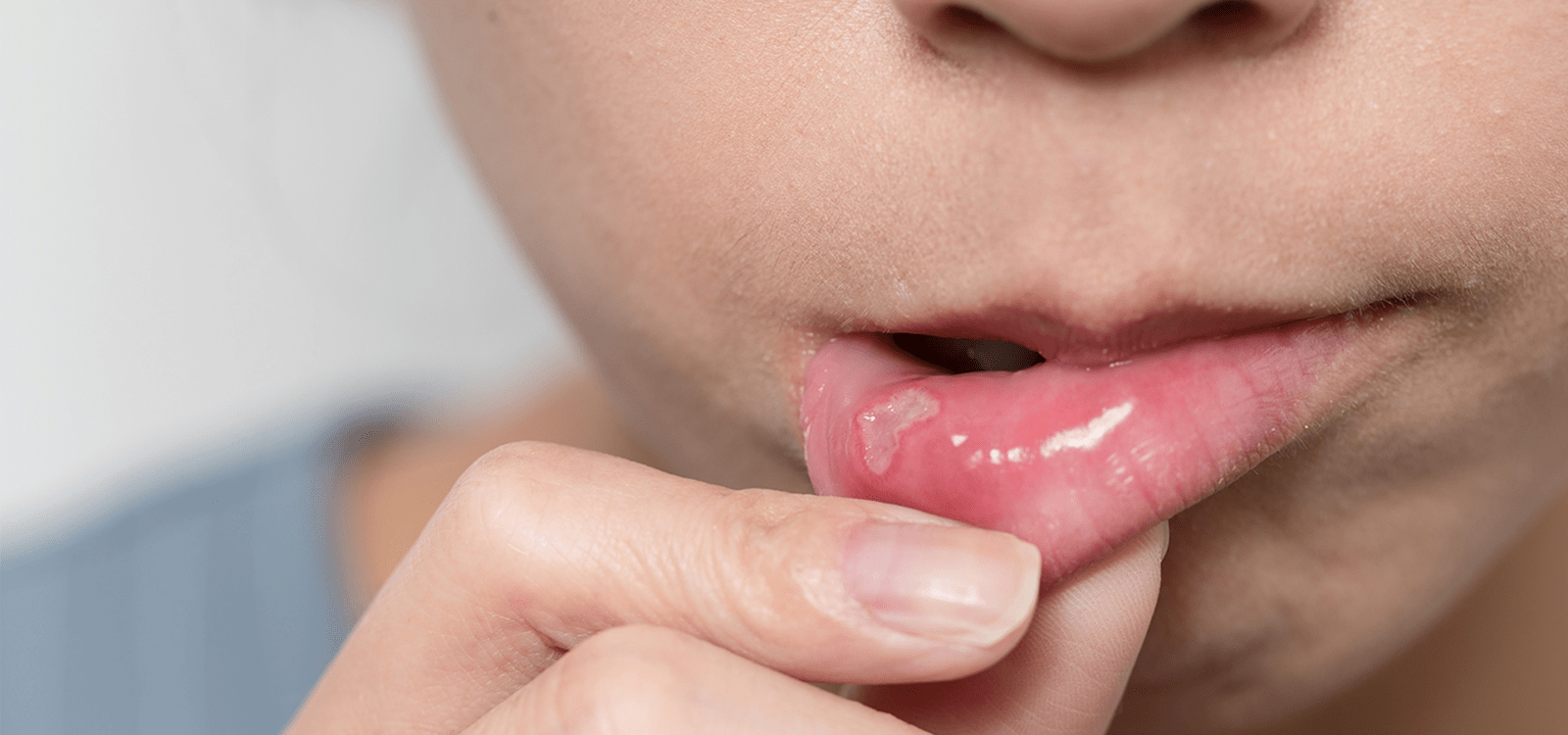 Как лечить стоматит у взрослых: причины, симптомы, средство от стоматита во рту