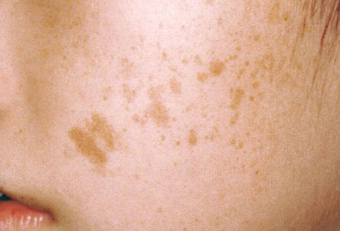 Темные пятна на теле: фото, возможные болезни, лечение | заболевания кожи