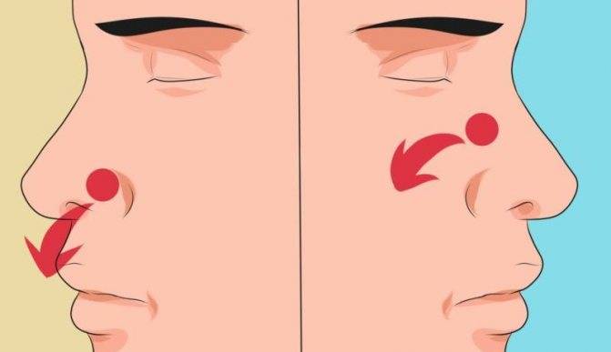 Кровотечение носовое: как остановить в домашних условиях