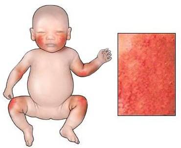 Аллергический дерматит у детей