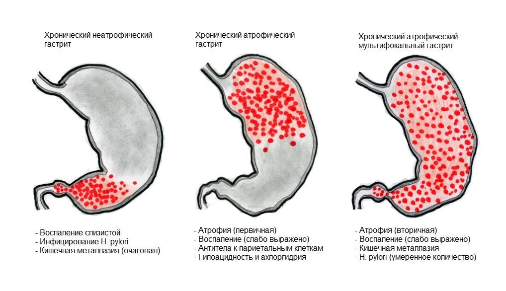 Геморрагический гастрит: как развивается, симптомы и методы лечения