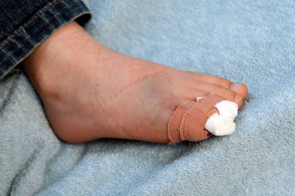 Перелом пальца на ноге: как определить, симптомы, признаки, лечение, как понять что сломан, нужен ли гипс