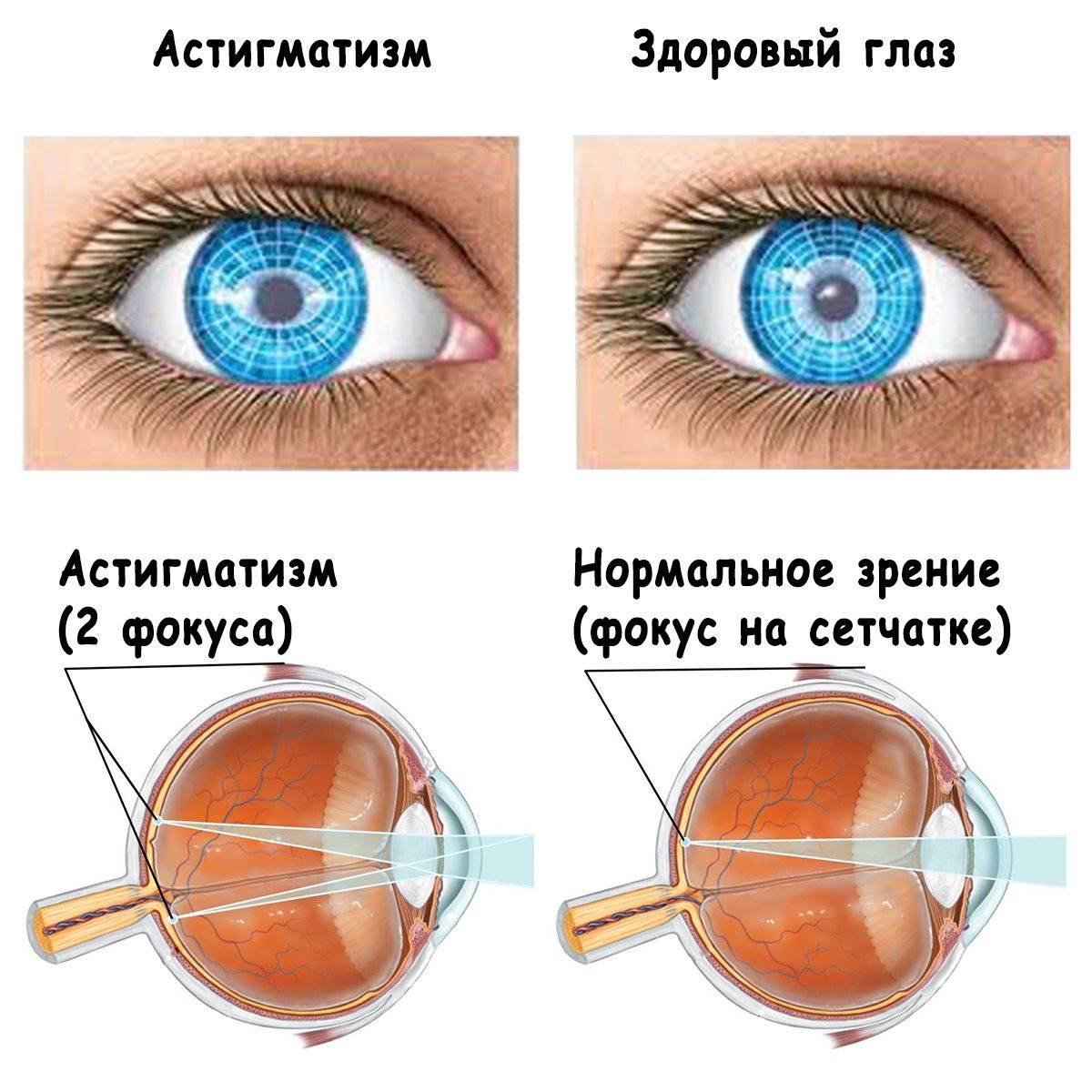 Скольки лет можно линзы. Сложный миопический астигматизм обоих глаз. Сложный гиперметропический астигматизм. Смешанный гиперметропический астигматизм. Сложный гиперметропический астигматизм глаза.