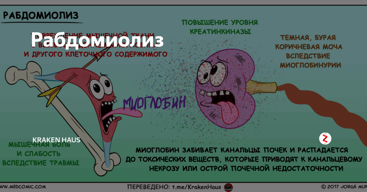 Рабдомиолиз. Рабдомиолиз лекарства. Рабдомиолиз миоглобин.