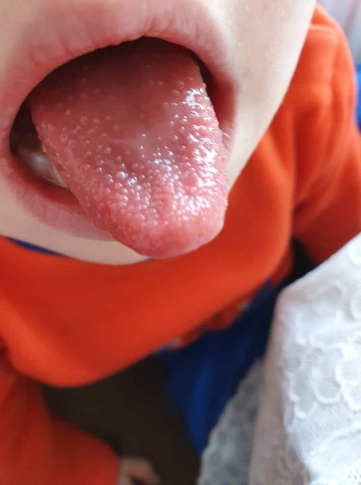 Скарлатина у детей: симптомы, как выглядят первые признаки у ребенка, болезнь без сыпи и температуры