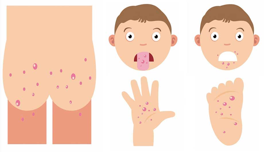Скарлатина у детей: первые признаки, причины и особенности протекания инфекционного заболевания