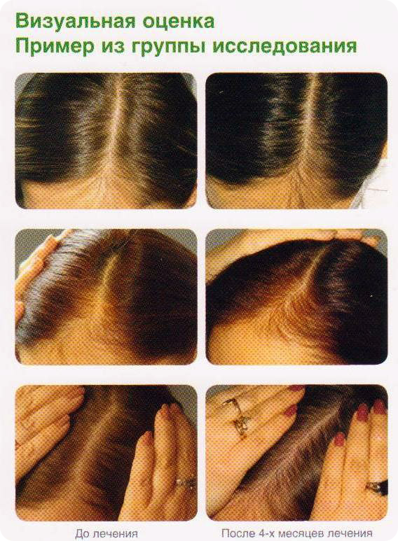 Признаки сильных волос. Пробор волос у женщин при выпадении. Норма выпадения волос. Сильное облысение у женщин.
