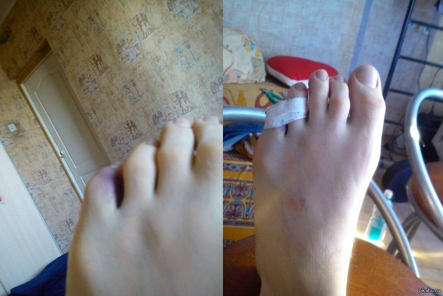 Как разрабатывать палец после перелома: на руке, на ноге, после гипса, реабилитация, упражнения, лфк, физиотерапия