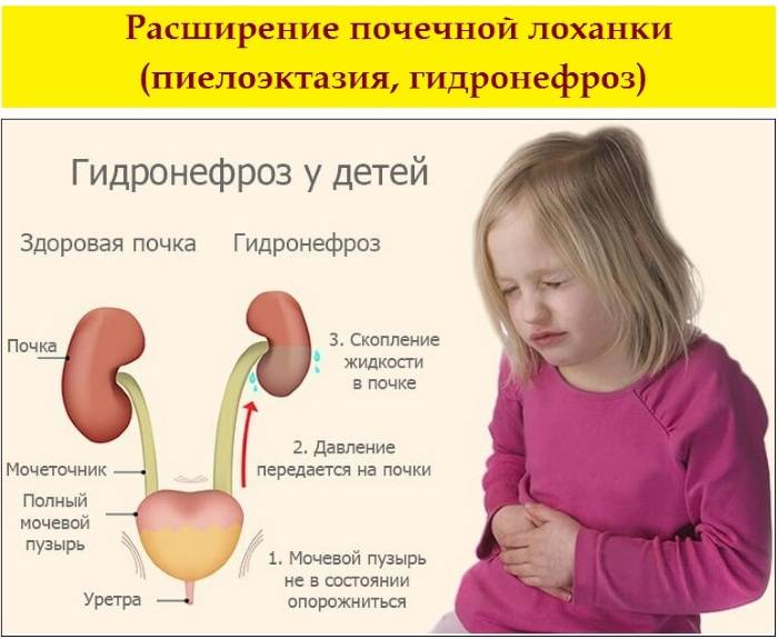 Пиелоэктазия почек у ребенка - что это такое, какие симптомы, как лечить заболевание?
