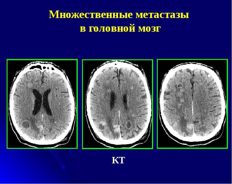 Метастазы в головном мозге: особенности лечения и прогноз