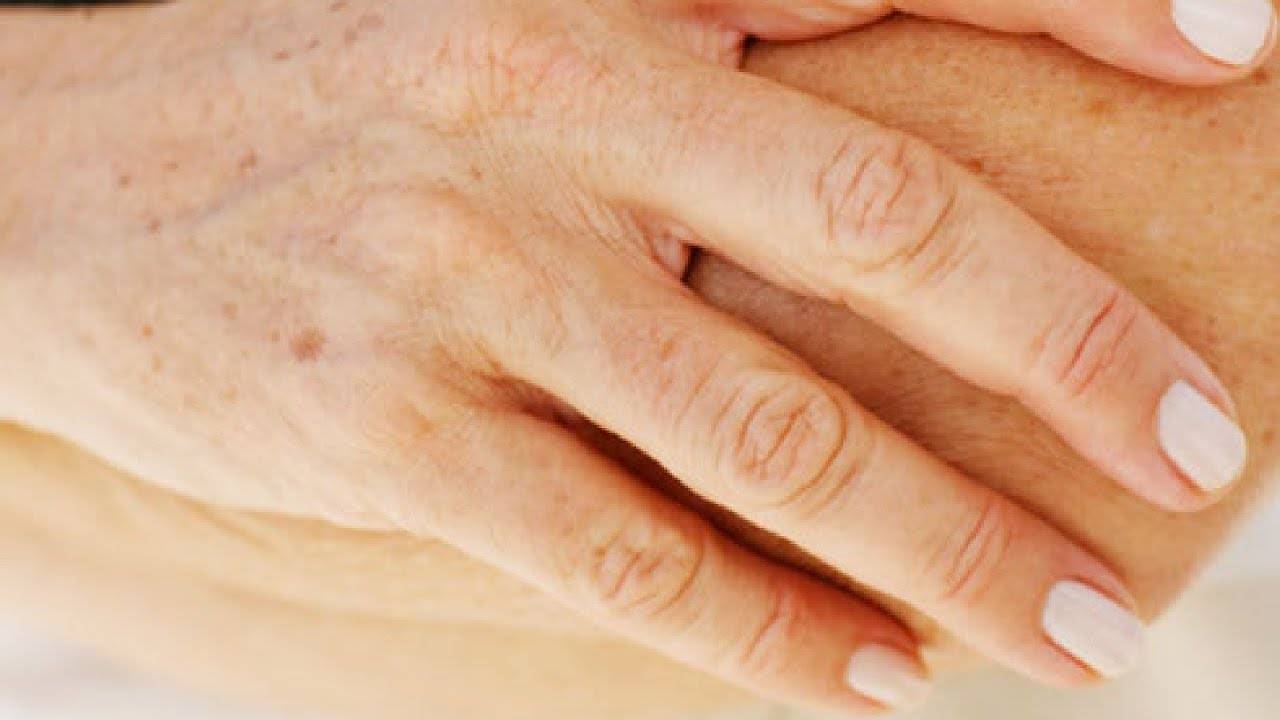 Как избавиться от пигментных пятен на руках в пожилом возрасте?
