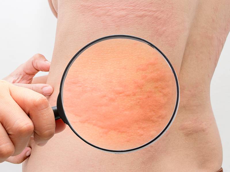 Нервный дерматит: крапивница на нервной почве, аллергия и сыпь от стресса на коже, как лечить