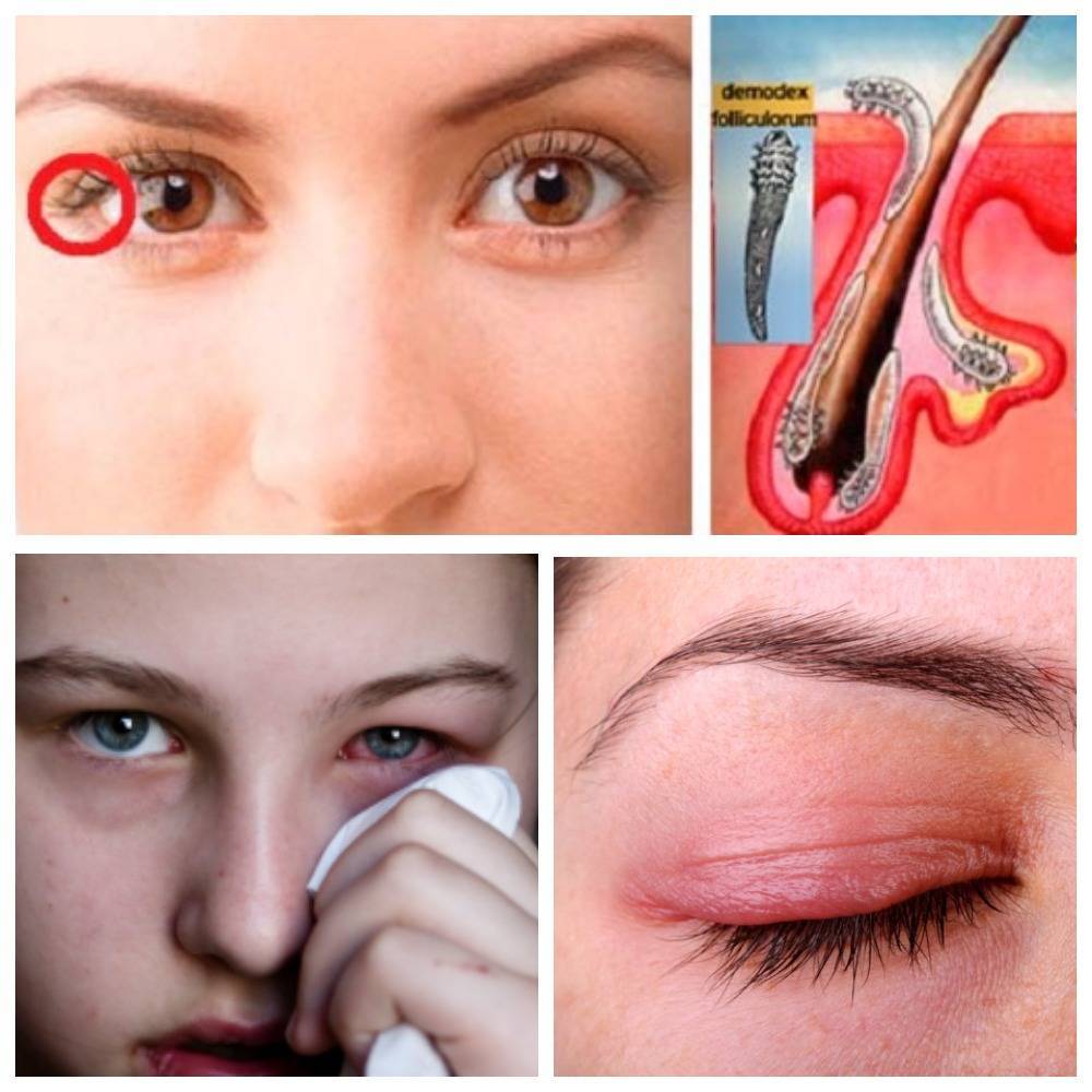 Демодекс глаз: лечение и возможные симптомы у человека