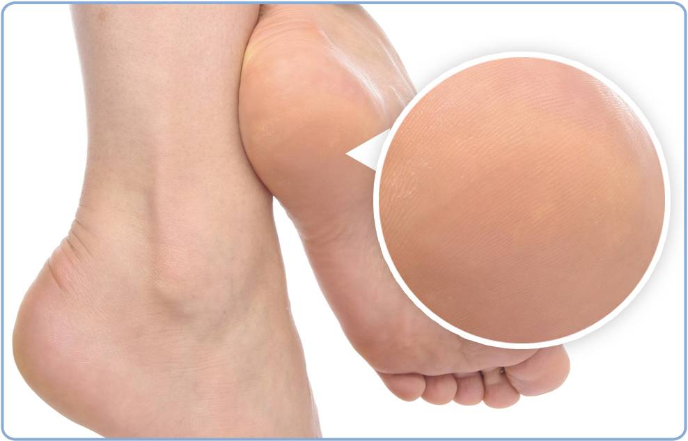 Сухая кожа на ногах: причины и лечение, как избавиться, рецепты домашних масок и ванночек