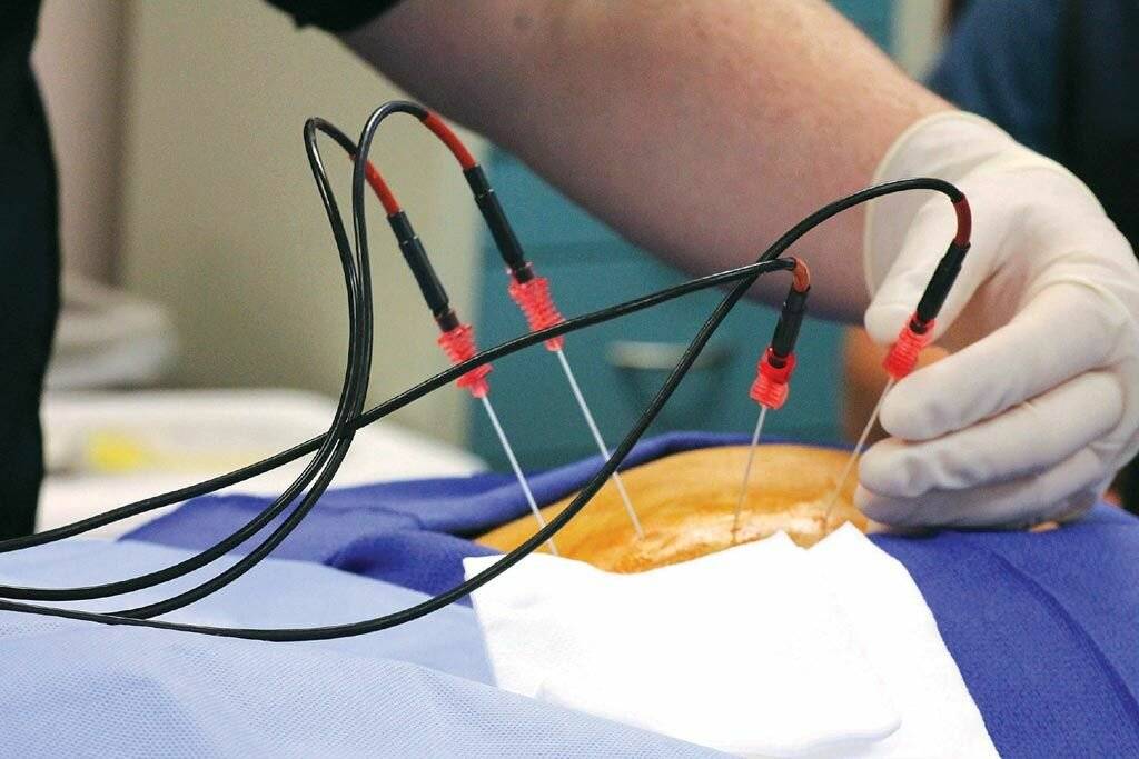 Радиочастотная абляция позвоночника | лечение суставов