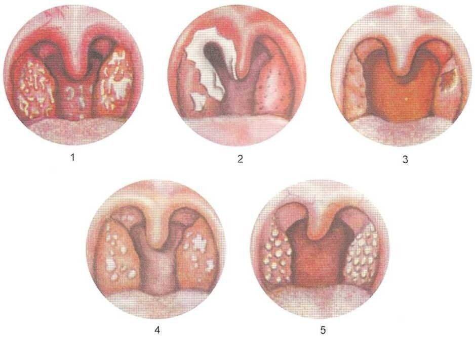 Как лечить бактериальную ангину – лечение тонзиллита в горле