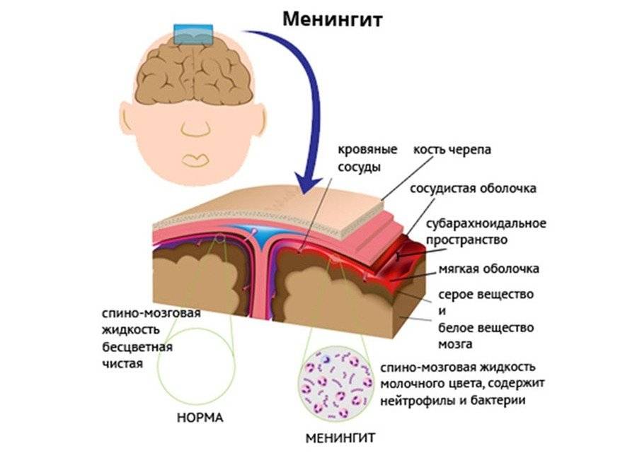 Как передается вирусный менингит? симптомы у детей, инкубационный период, лечение и последствия
