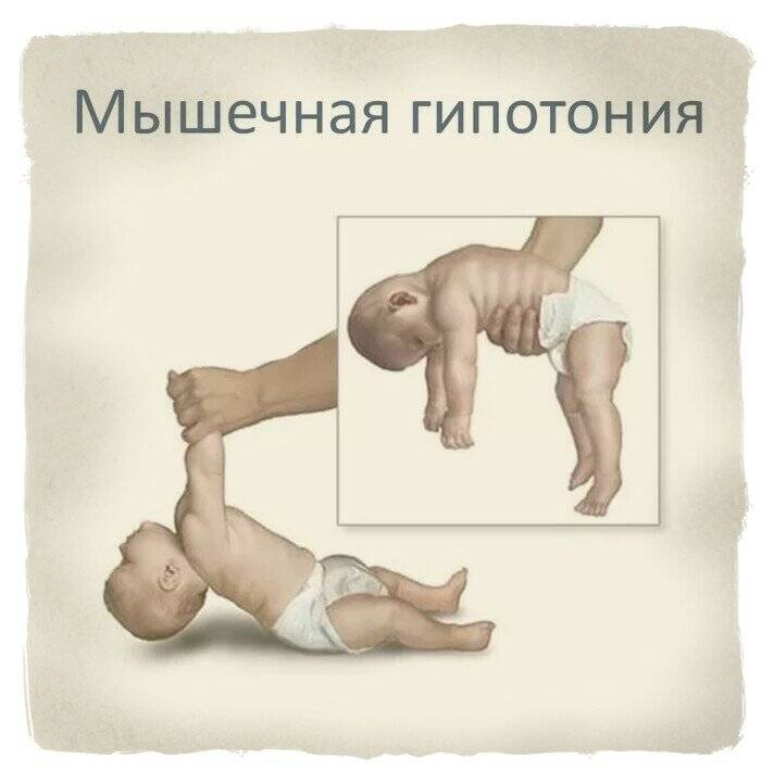Мышечный тонус у детей: гипотонус, гипертонус, дистония / mama66.ru