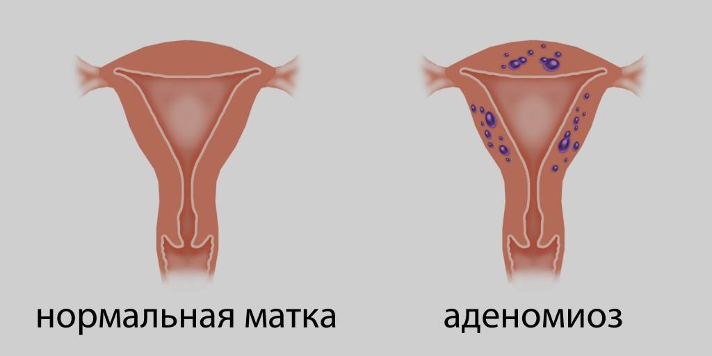 Лечение эндометриоза у женщин: препаратами, народными средствами