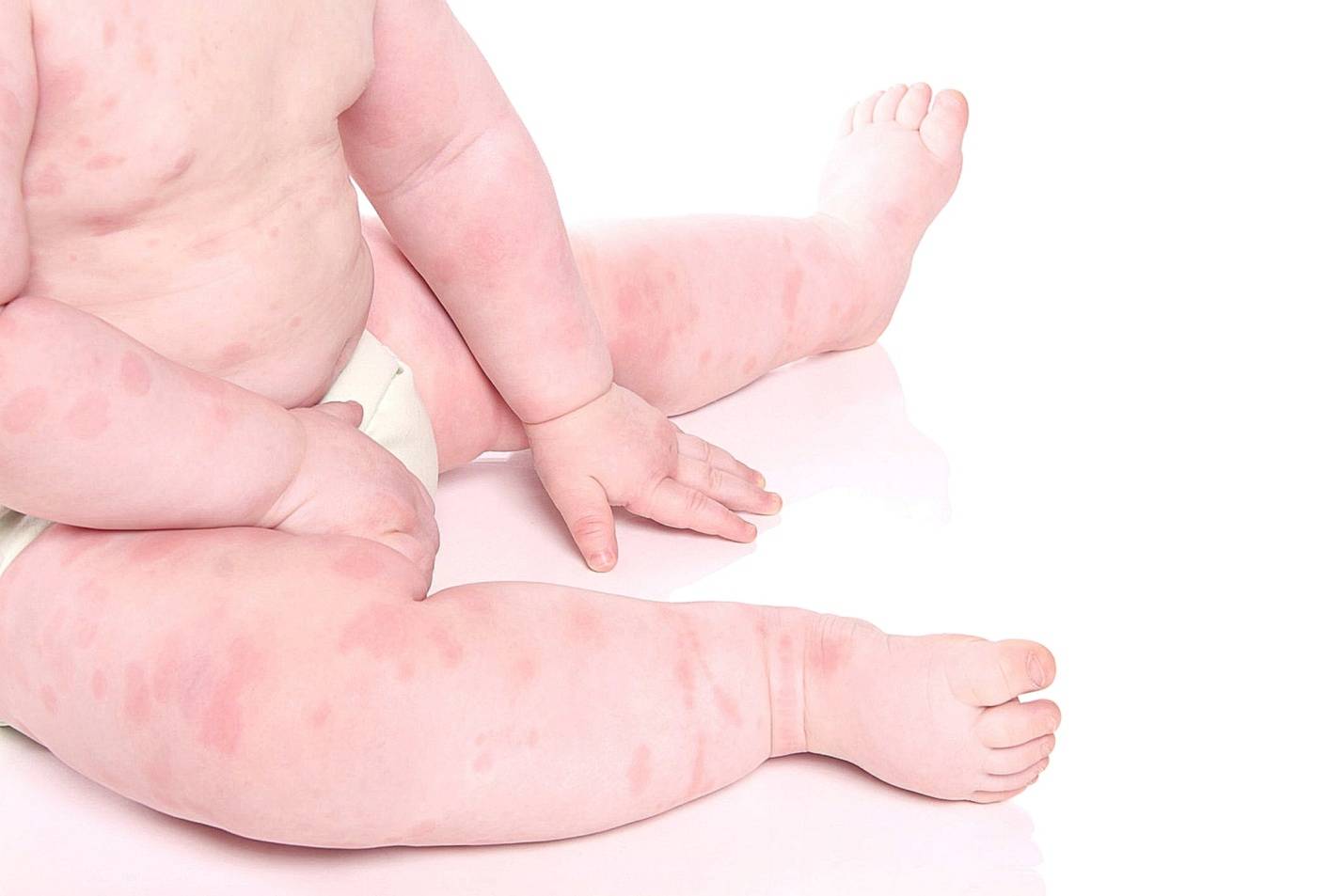 Аллергический дерматит у детей (29 фото): симптомы и лечение грудничков и новорожденных, кремы и мази в домашних условиях