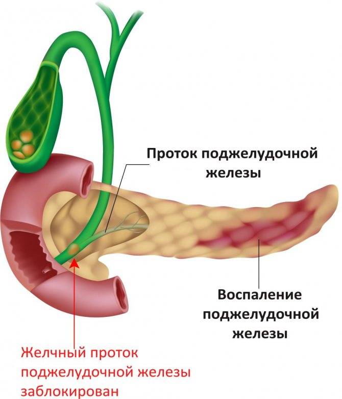 Поджелудочная железа диффузные изменения по типу липоматоза народными средствами