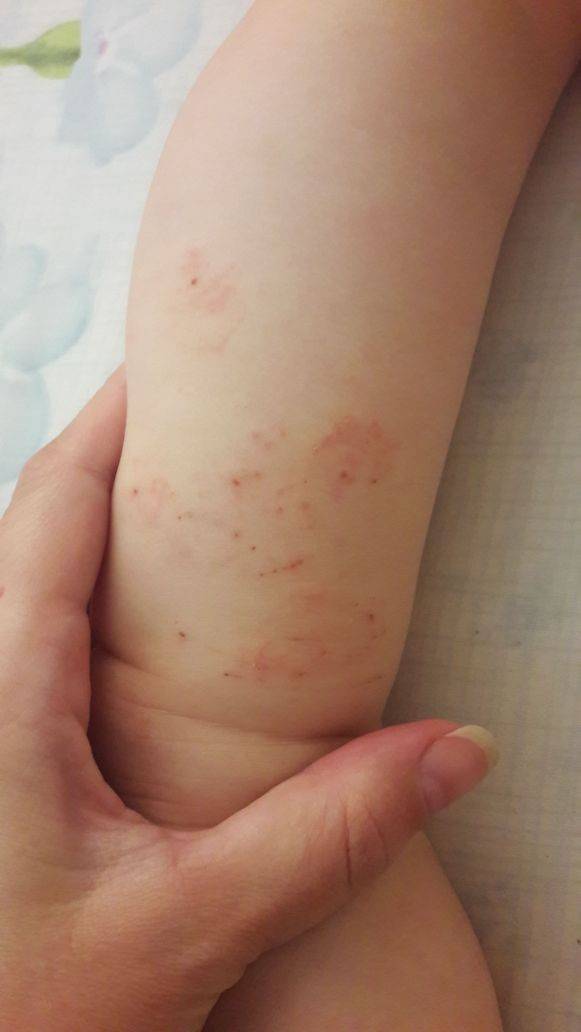 Аллергические высыпания на коже у взрослых и детей (фото): лечение сыпи