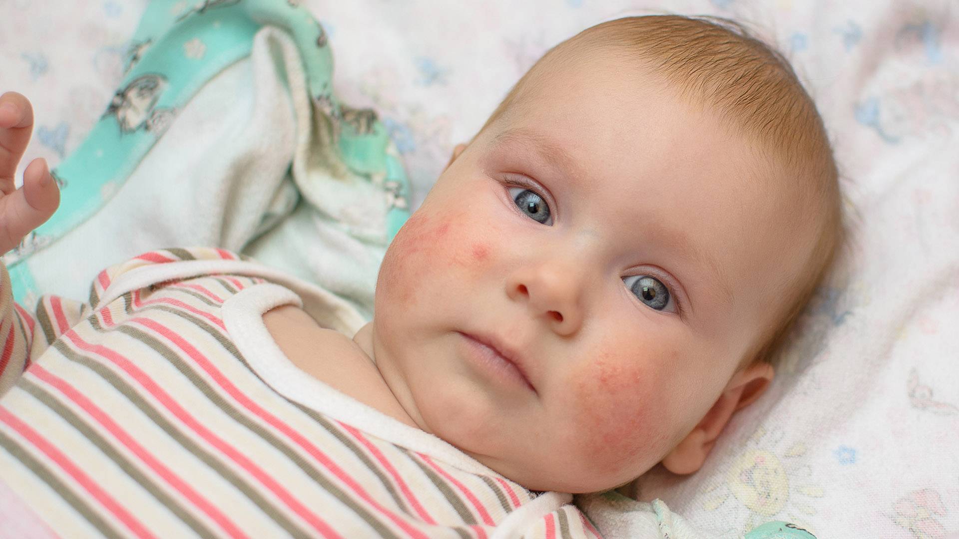 Перианальный дерматит у ребенка фото