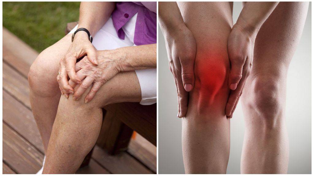 Гонартроз коленного сустава 3 степени, лечение артроза без операции народными средствами