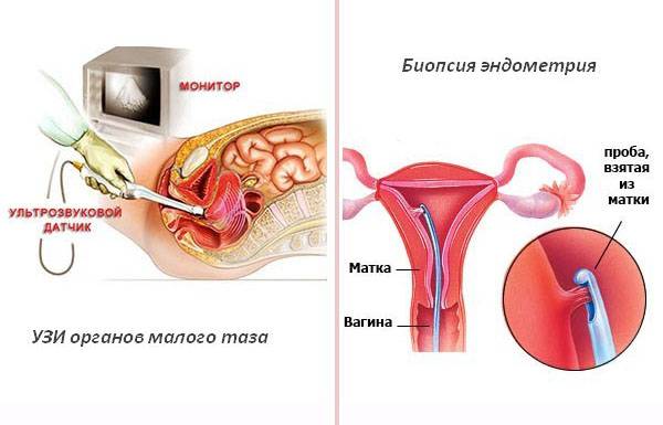 Гиперплазия эндометрия в период менопаузы