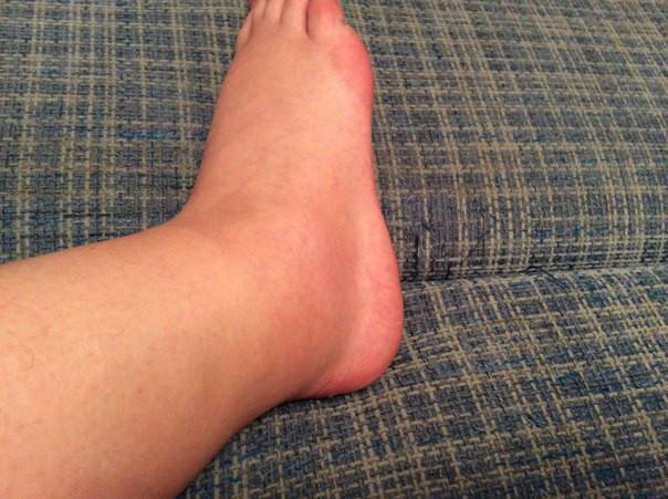 Боли и отечность ног. Рожистое воспаление голеностопа. Бурсит голеностопного сустава. Гемартроз голеностопного сустава.