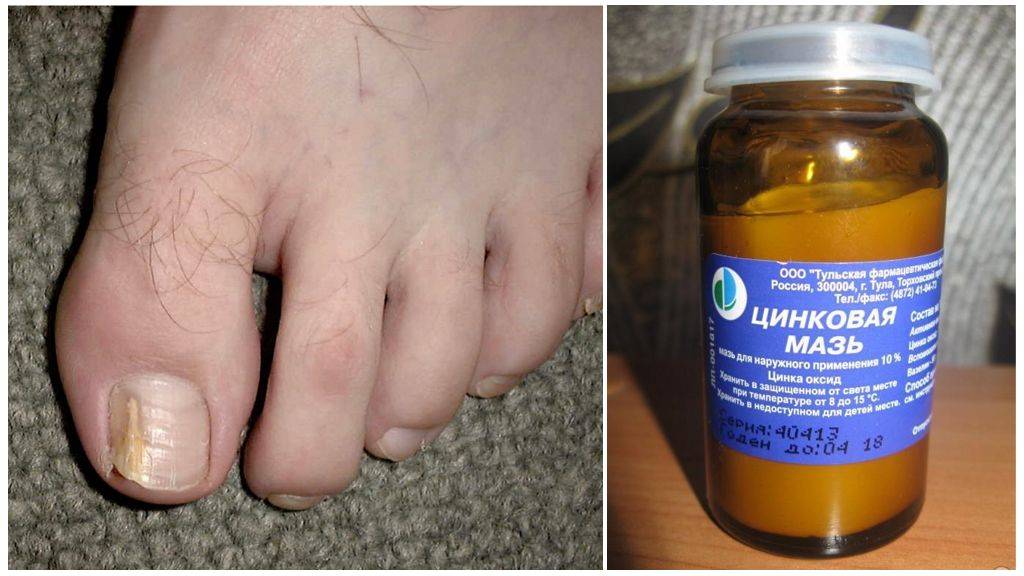 Самостоятельное лечение запущенной формы грибка ногтя на ногах и руках: лучшие средства