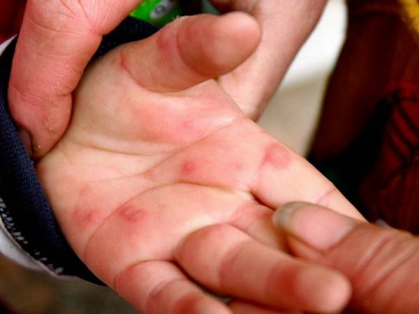 Комаровский - чем лечить вирусную пузырчатку у детей: фото, симптомы, лечение