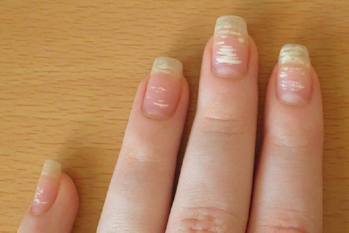 Белые пятна на ногтях у ребенка: причины и лечение