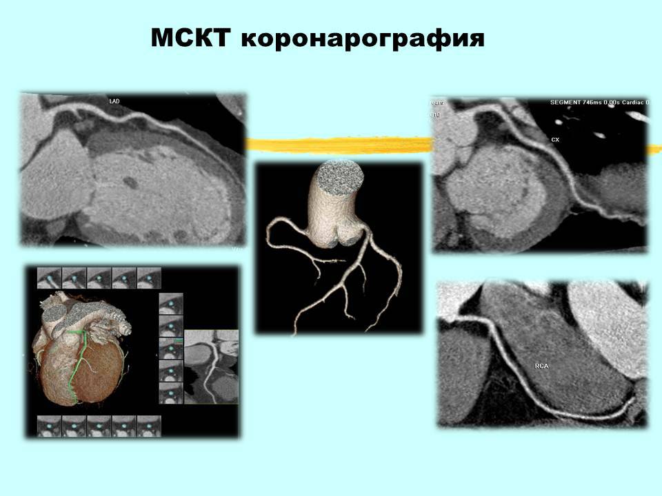 Коронарография сосудов сердца, сделать контрольную кт-коронарографию в москве - клиника цэлт