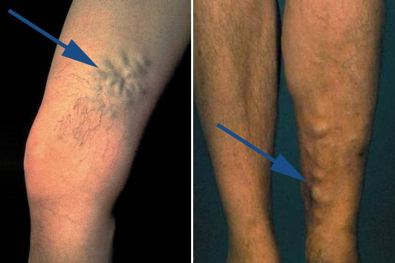 Лечение варикоза на ногах. как лечить варикоз быстро в домашних условиях? | здоровье человека