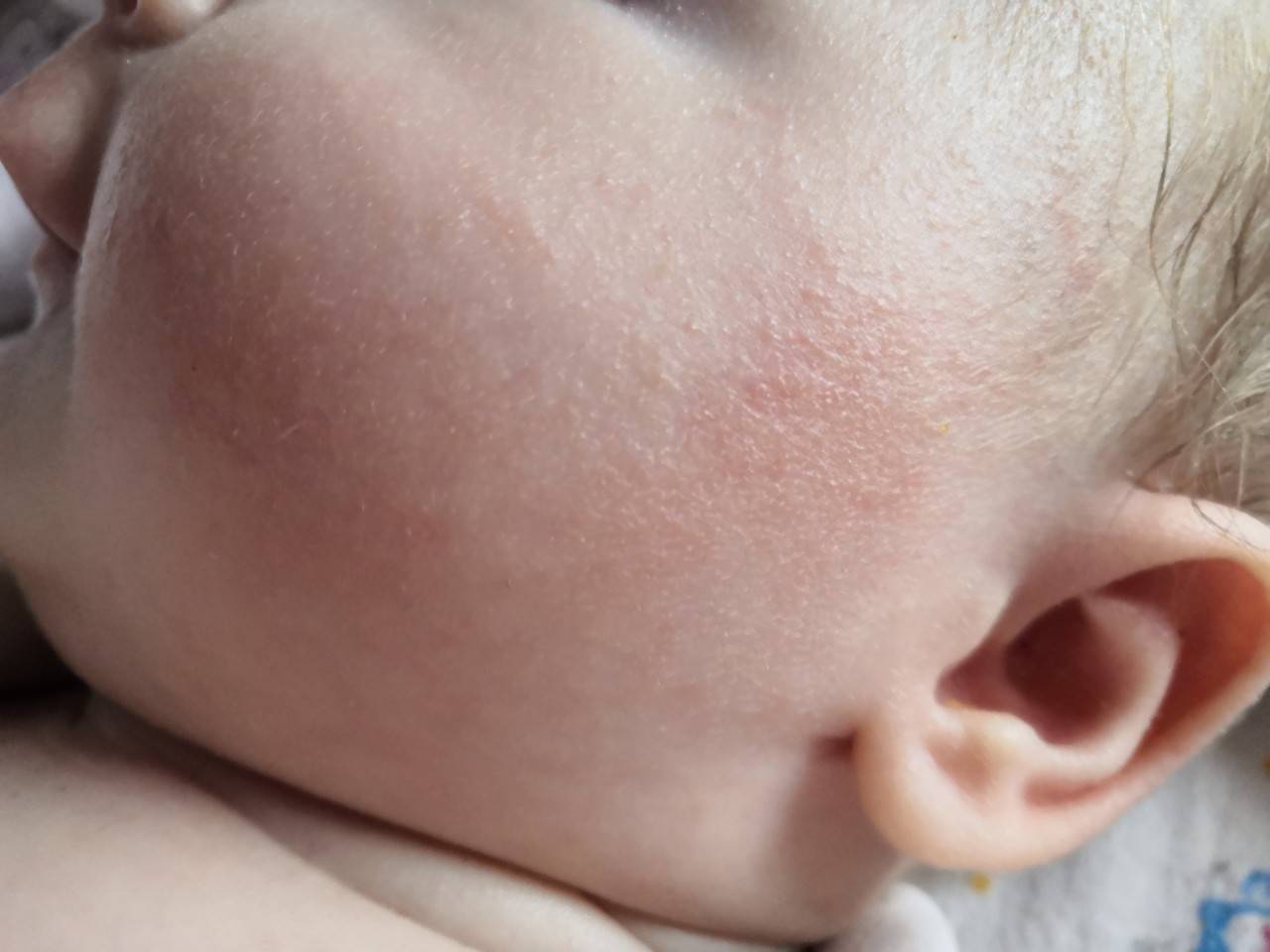 Потница у новорожденных, грудничков (49 фото): симптомы инфицированной формы, как лечить и избавиться в домашних условиях опрелости на голове, попе, спине, теле и животе