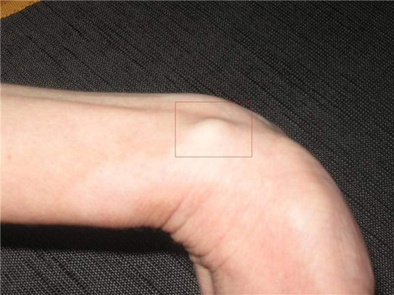 На пальцах рук появились шишки: как выглядят, фото. причины появления шишек на пальцах рук. лечение шишек на пальцах рук: медикаментозные и народные средства
