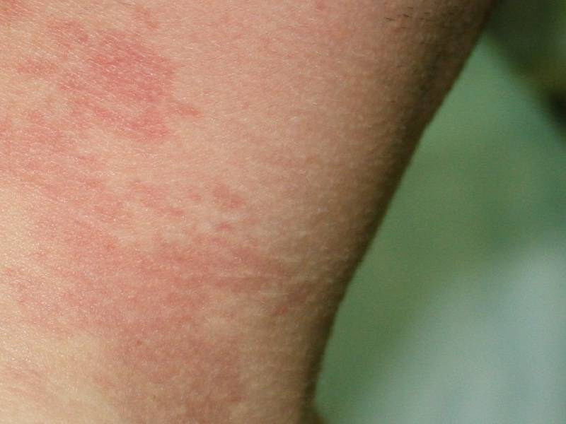 Нервный дерматит: крапивница на нервной почве, аллергия и сыпь от стресса на коже, как лечить - гармония внутри