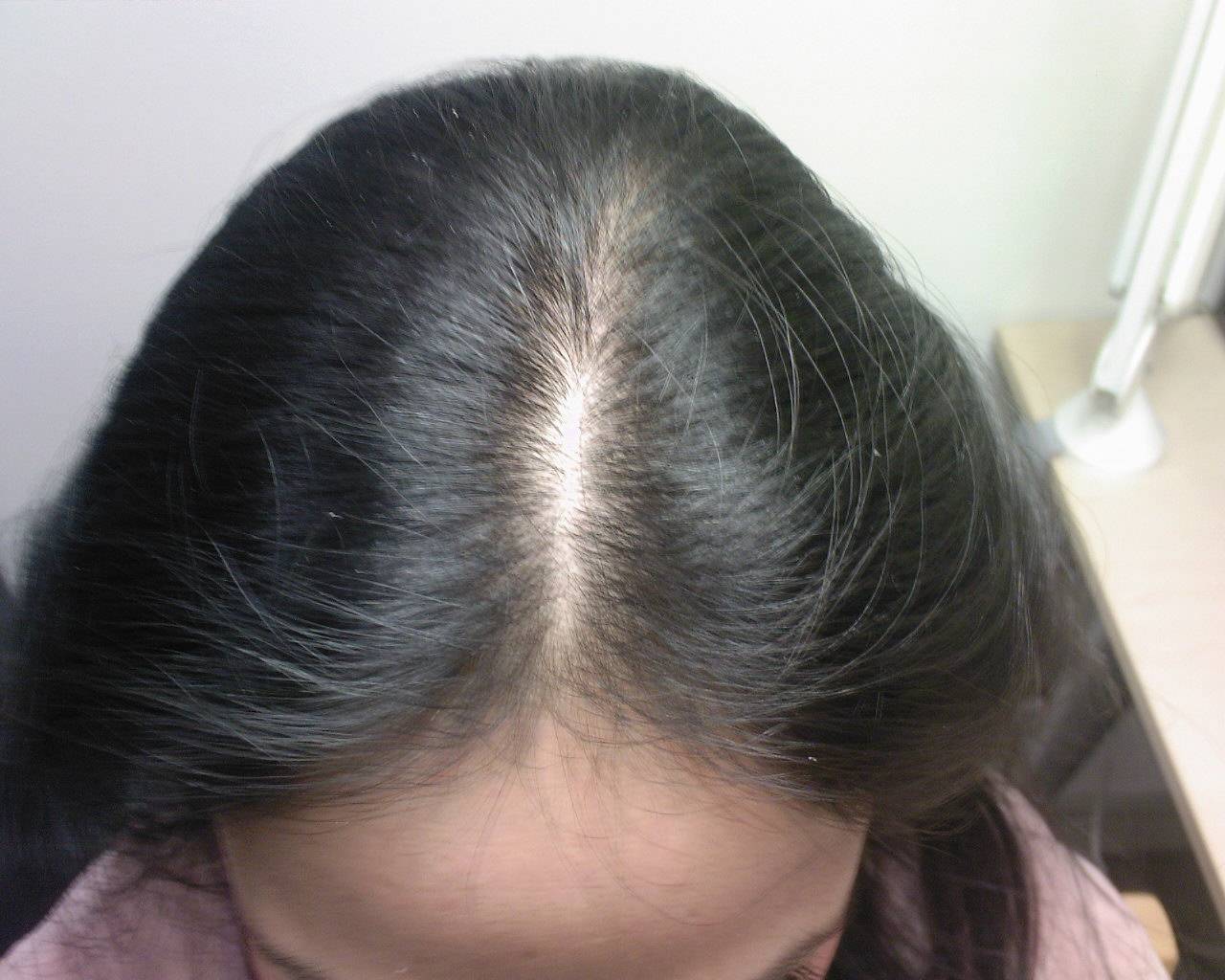 Отечность выпадение волос. Андрогенетическая алопеция. Андрогензависимая алопеция. Гиперандрогенная алопеция. Гнёздная (очаговая алопеция).