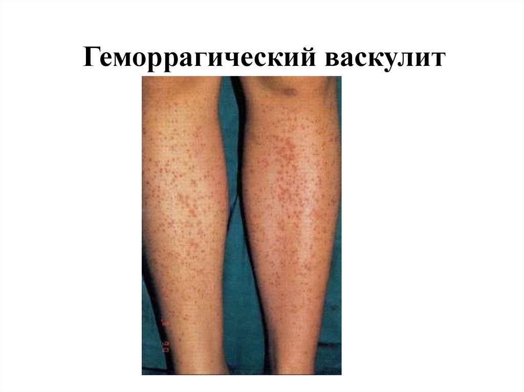 Геморрагический васкулит. фото у взрослых, детей, диагностика, лечение — medists.ru