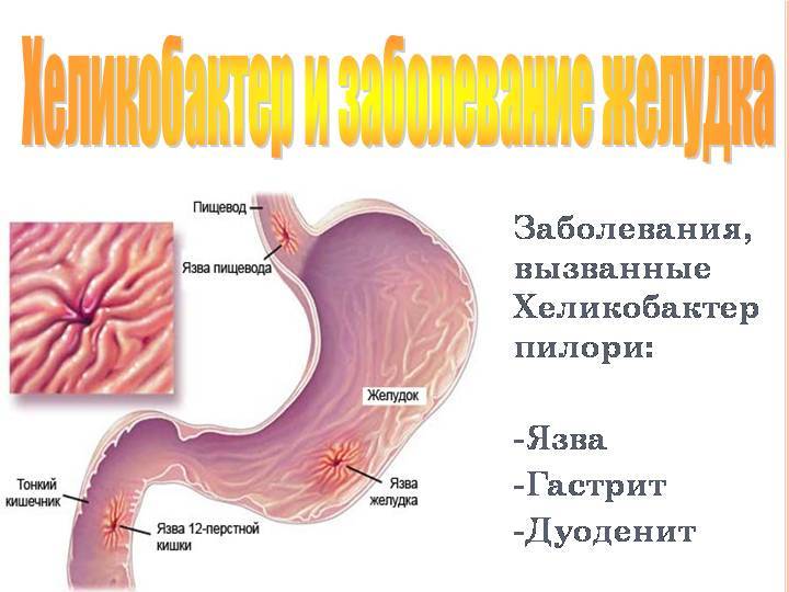Как лечить дисбактериоз желудка и кишечника