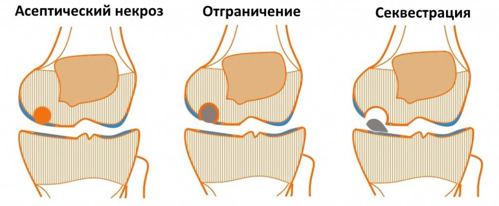 Болезнь кенига коленного сустава или рассекающий остеохондрит