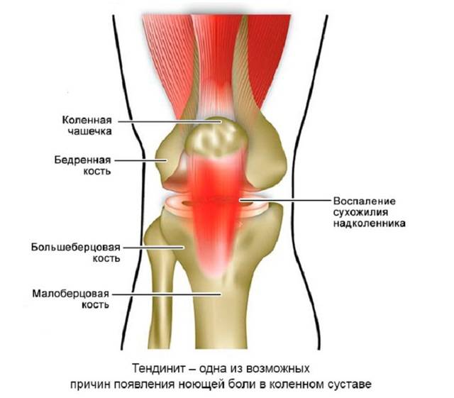 Почему при ходьбе болит колено и что делать для его лечения