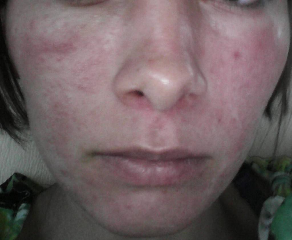 Красные пятна на лице: причины появления и лечебные методики