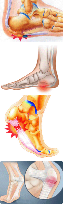 Почему болят ступни ног и больно ходить – причины, методы лечения патологии