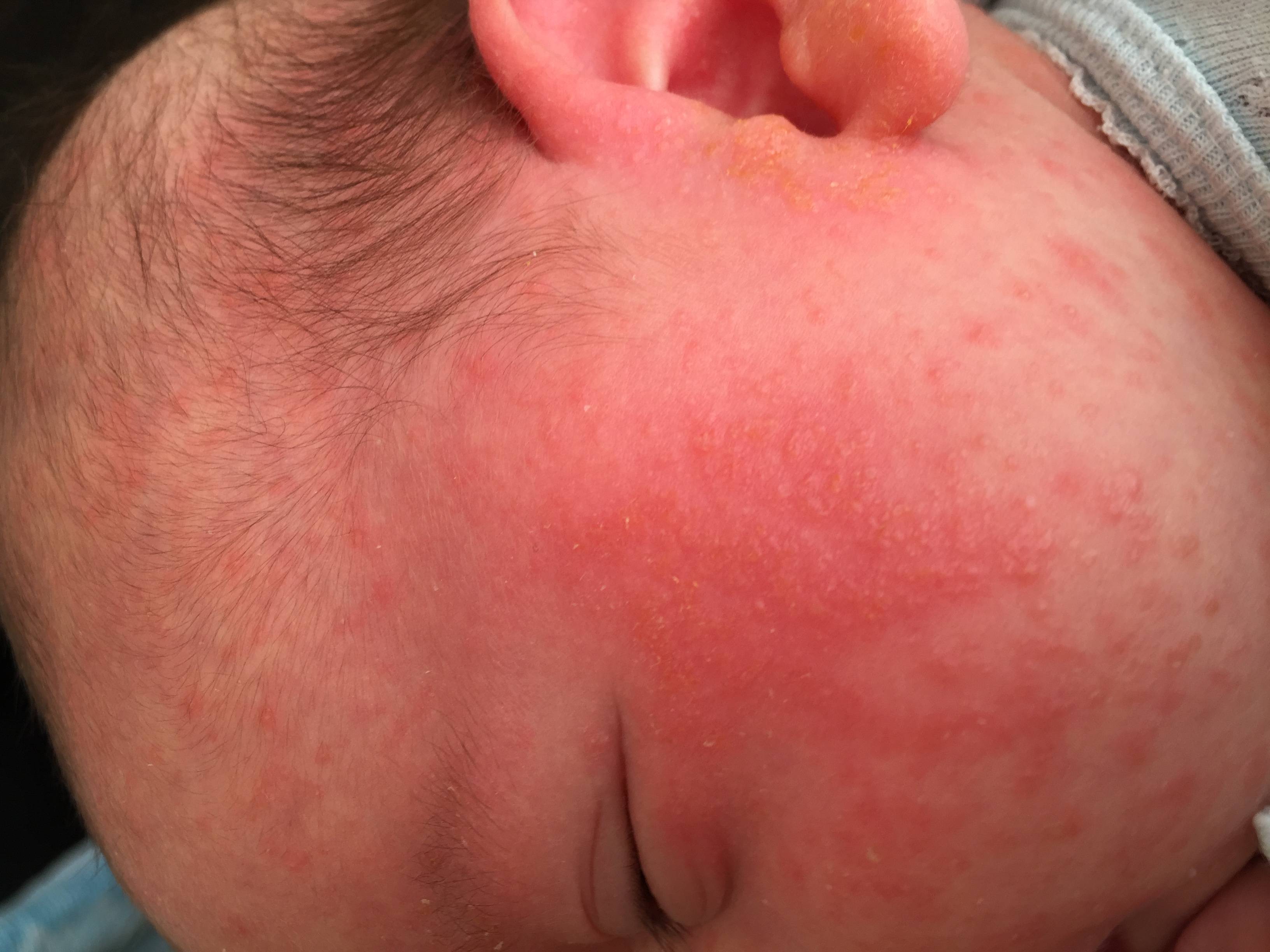 Потница на шее у грудничка и новорожденных (21 фото): как избавиться от потнички, как выглядит
