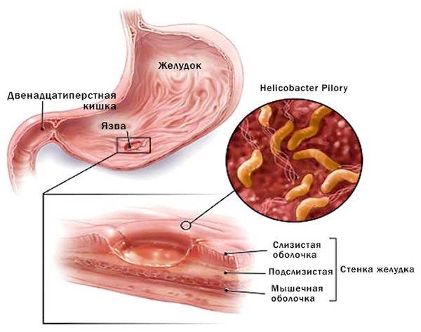 Микрофлора кишечника: симптомы и лечение