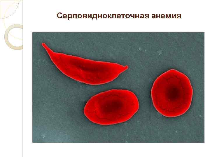 Серповидноклеточная анемия: причины, симптомы и лечение