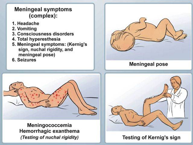 Симптомы менингита у взрослых: признаки как проявляется и как распознать, а также инкубационный период